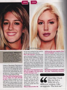 Heidi-Montags-Face-Before-and-After-Surgery